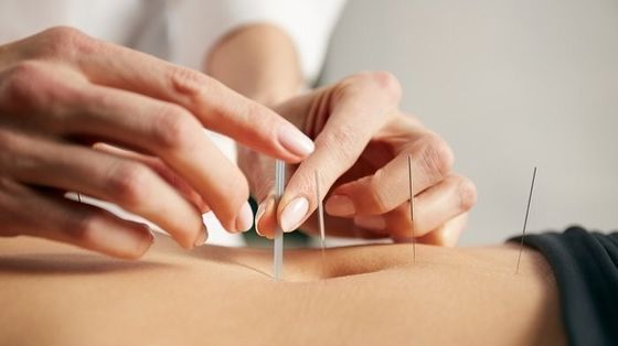 0.16mm ασημένιες ενδοδερμικές βελόνες βελονισμού για την ανακούφιση του πόνου